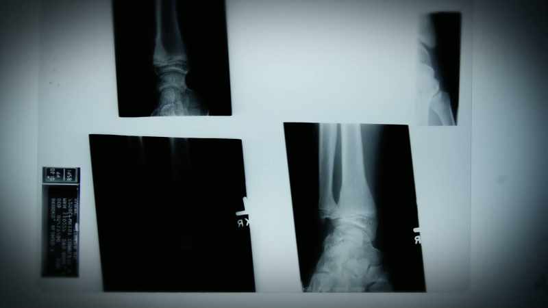 There's no broken bone