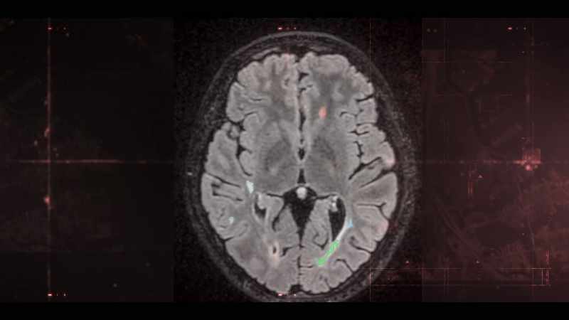 These cases were what we would call acute, non-progressing