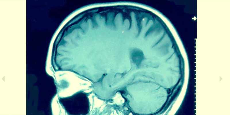 These tiny hemorrhages in the brain tissue