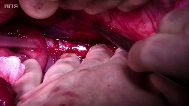 This is clearly monumental scale surgery