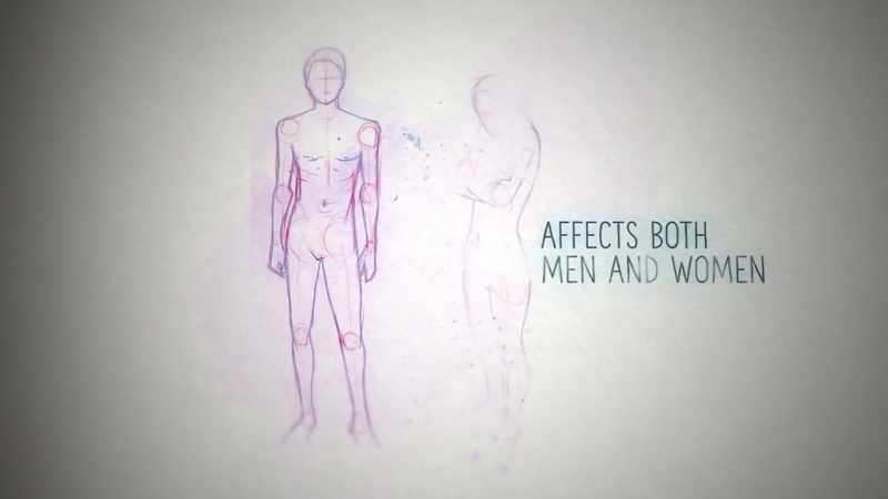 This distressing condition affects both men and women