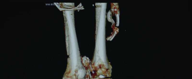 This fracture may have been complicated