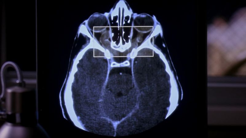 This our optic glioma guy?