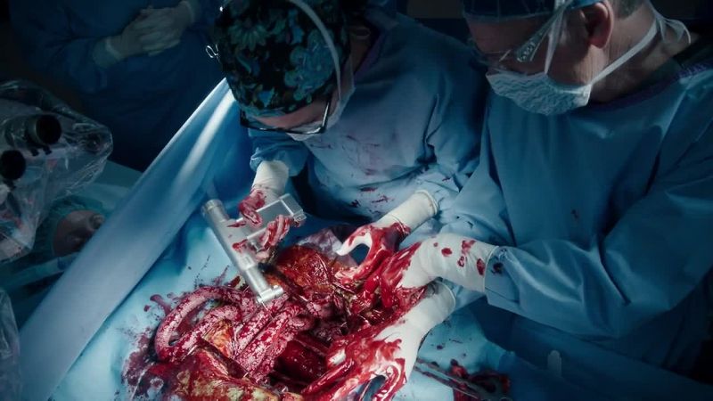 This tumor's eroded through the bone entirely