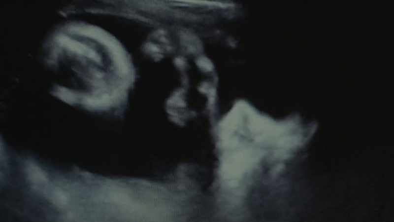 (ultrasound whirring)
