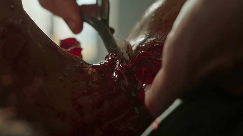 Using forceps to slip the linen under the artery
