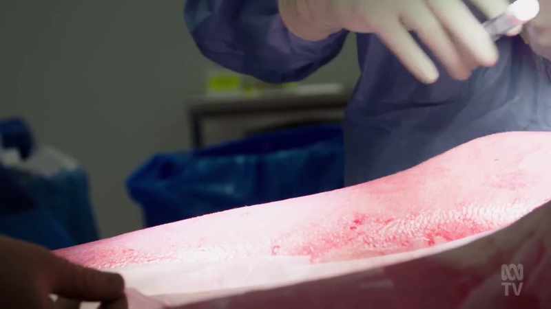 Using the patient's own cells