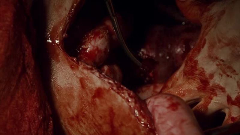 Was there damage to the spinal cord?
