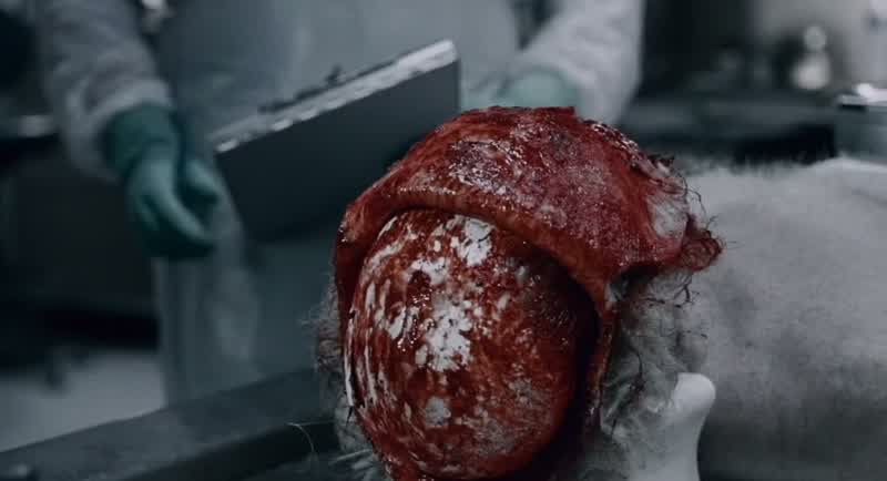 We have a recent dissection to the right occipital