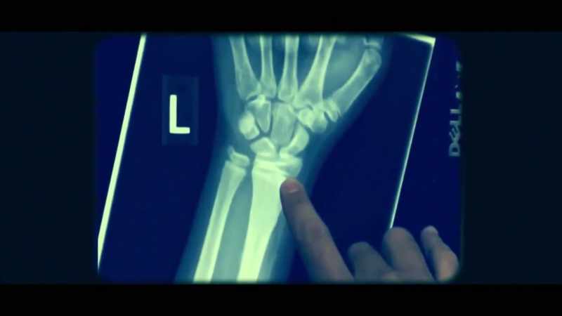 When a bone heals in a forearm