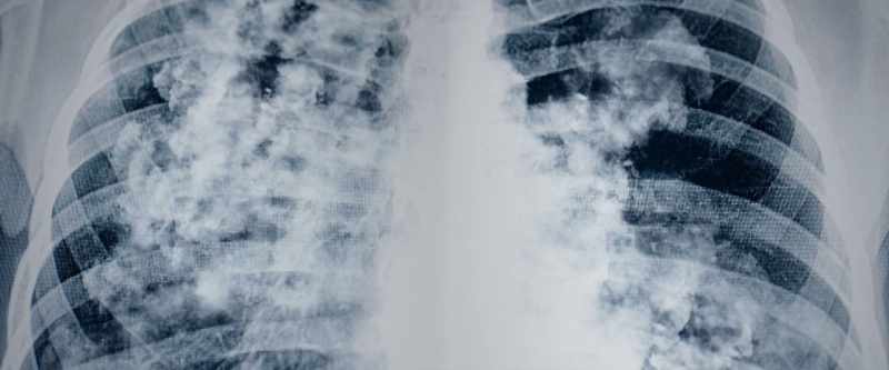 You'll see the mass in the left lower lung field